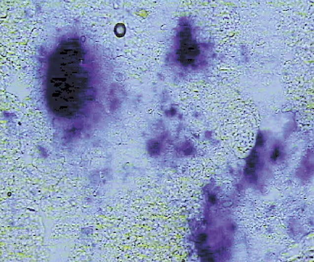 lacZ expression in mouse tumour tissue